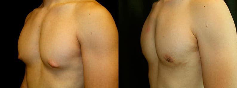 Gynecomastia Patient 10 Before & After Details