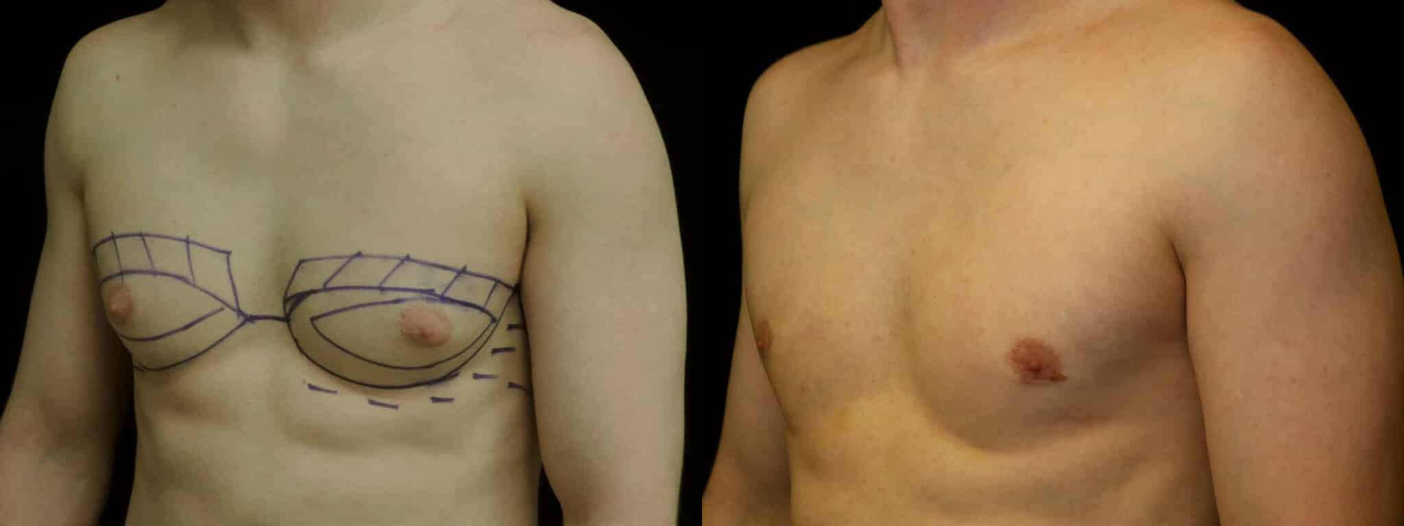 Gynecomastia Patient 2 Before & After Details