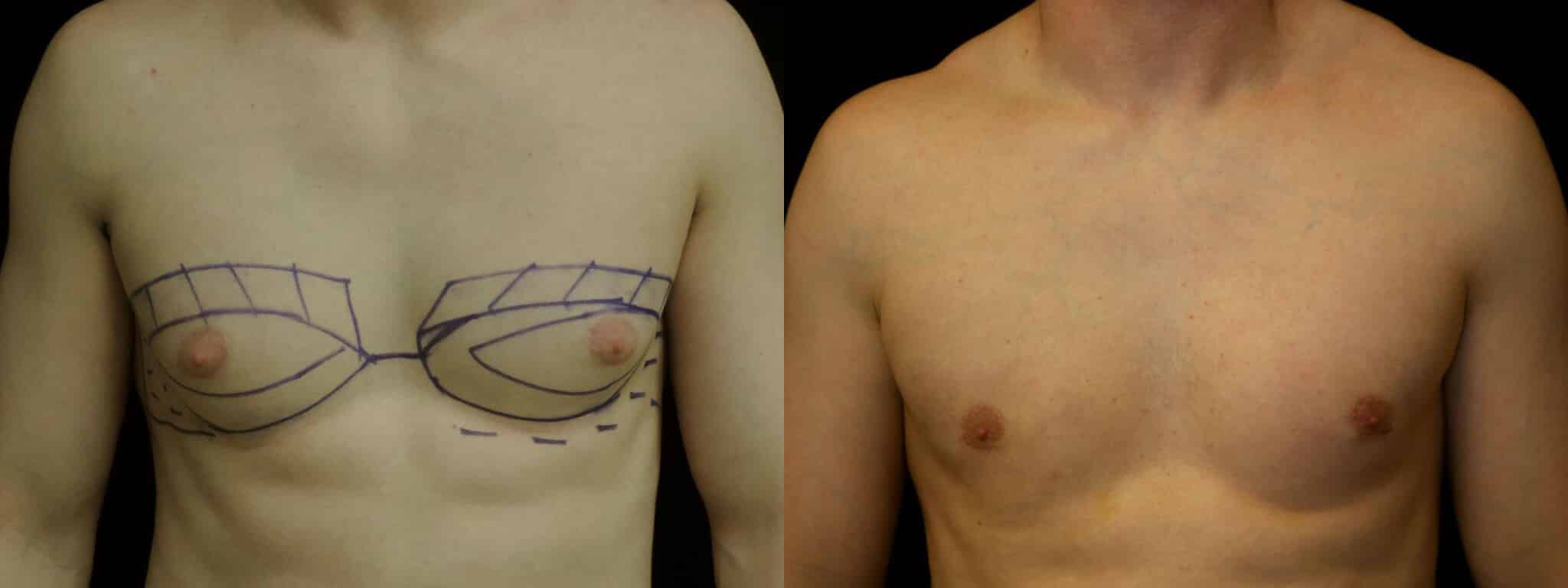 Gynecomastia Patient 2 Before & After