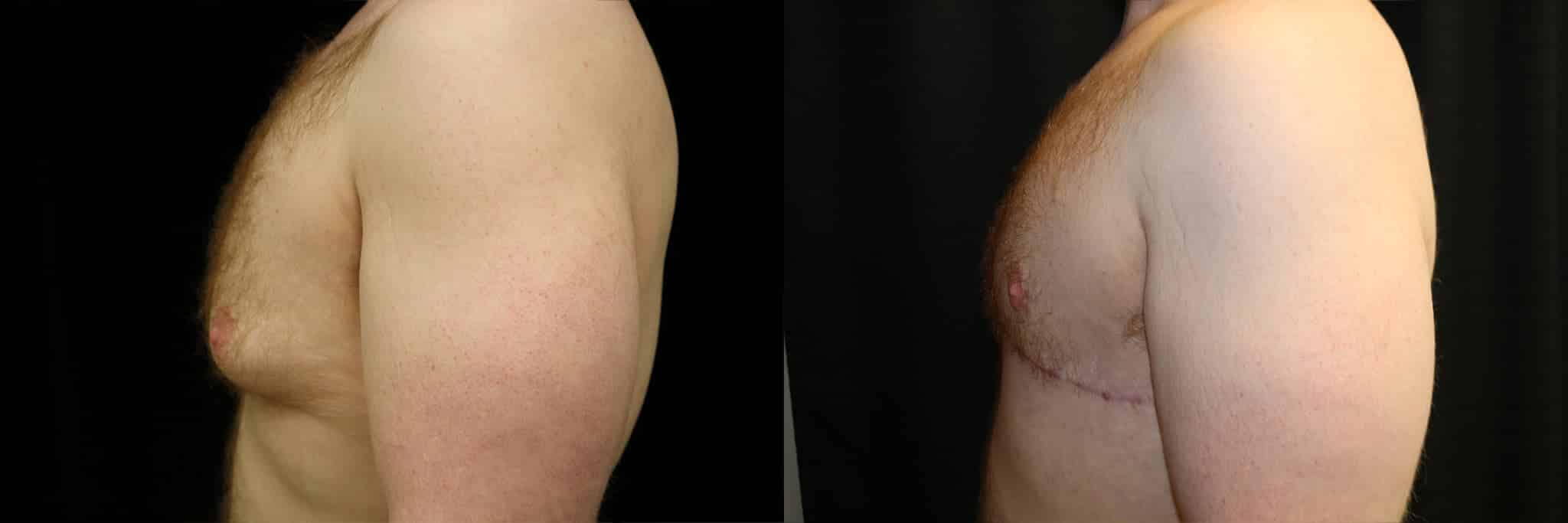 Gynecomastia Patient 5 Before & After Details