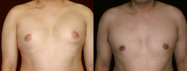 Gynecomastia Patient 10 Before & After