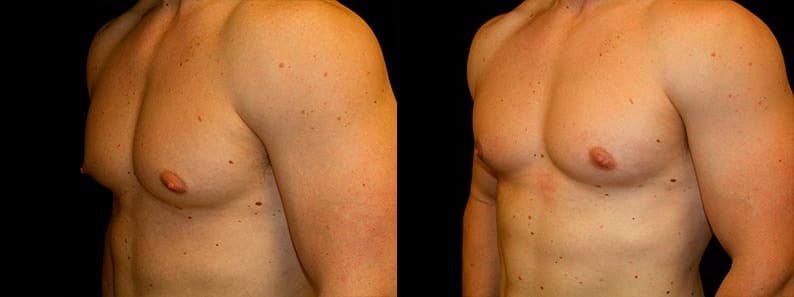 Gynecomastia Patient 18 Before & After Details