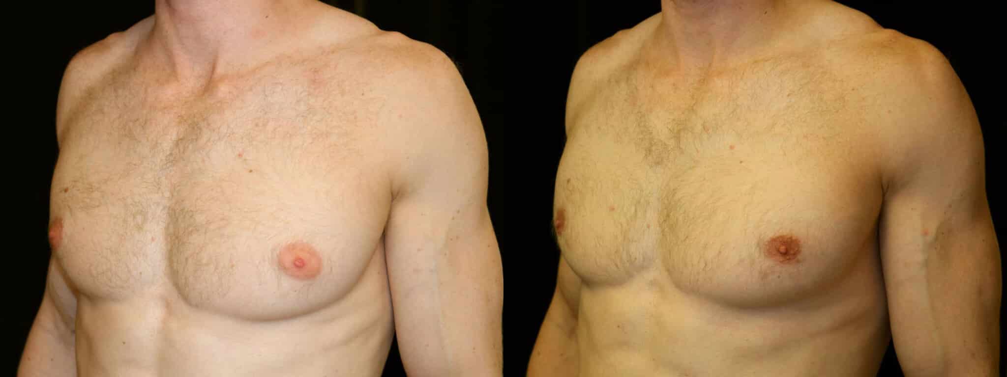 Gynecomastia Patient 7 Before & After Details