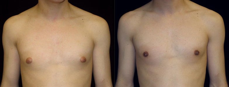 Gynecomastia Patient 8 Before & After