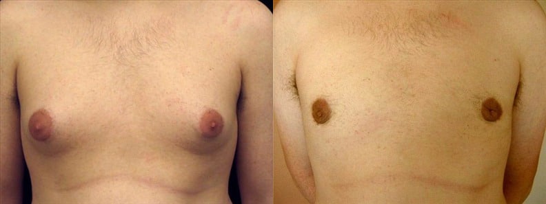 Gynecomastia Patient 6 Before & After