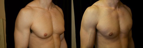 Gynecomastia Patient 17 Before & After Details