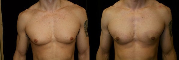 Gynecomastia Patient 17 Before & After