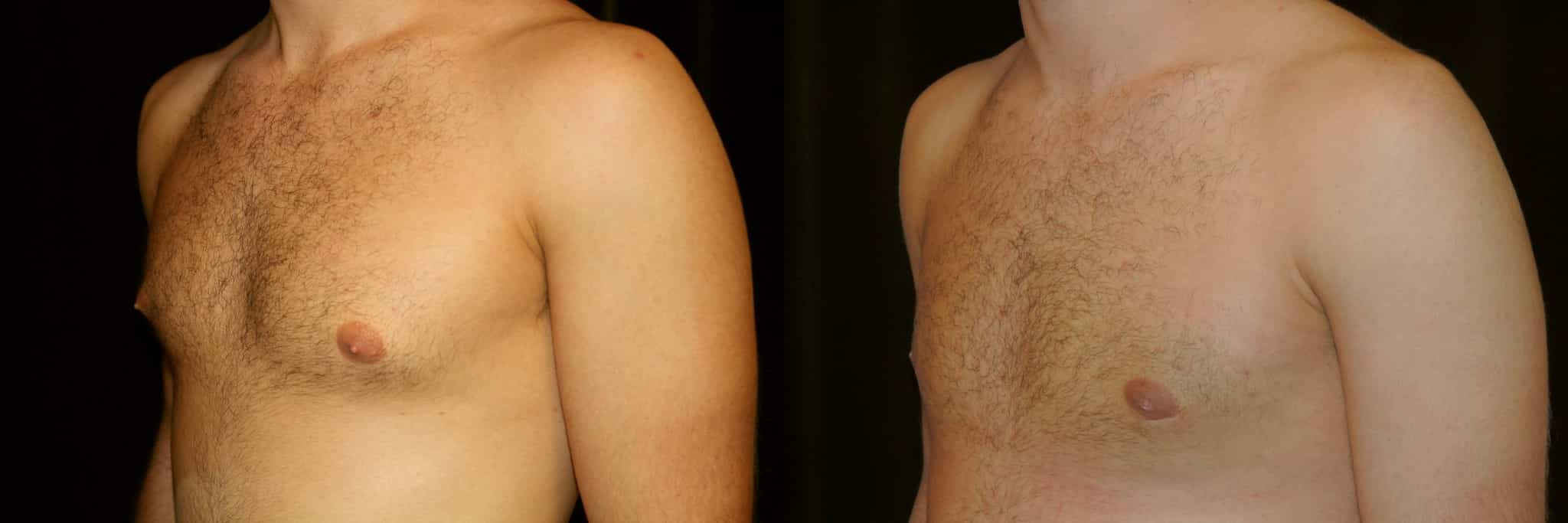 Gynecomastia Patient 13 Before & After Details