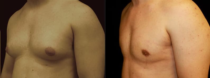 Gynecomastia Patient 4 Before & After Details