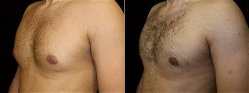 Gynecomastia Patient 20 Before & After Details