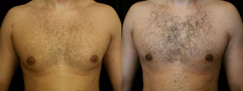 Gynecomastia Patient 20 Before & After