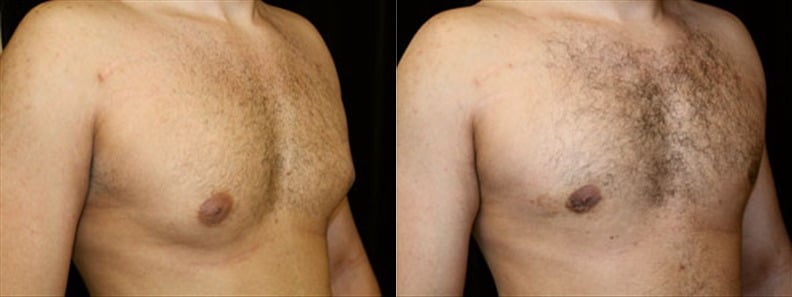 Gynecomastia Patient 20 Before & After Details