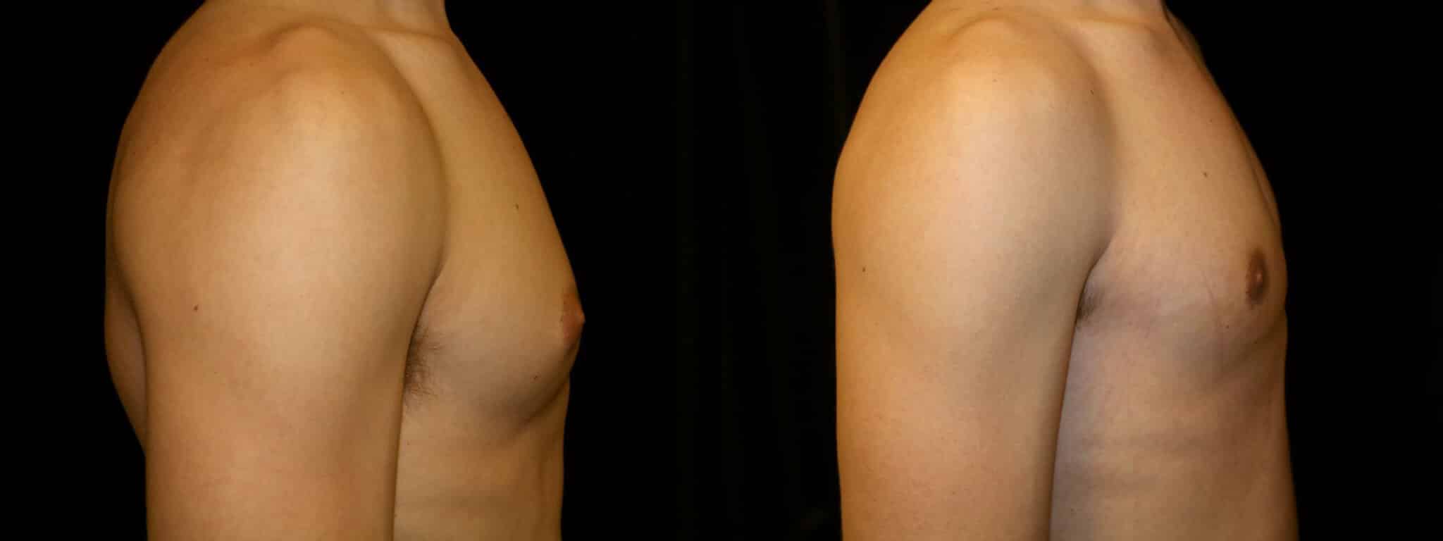 Gynecomastia Patient 11 Before & After Details