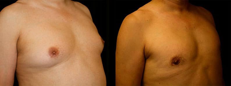 Gynecomastia Patient 7 Before & After