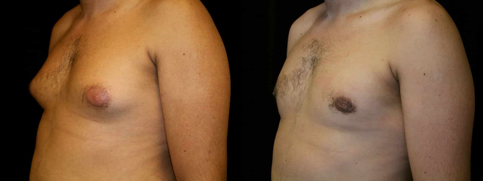 Gynecomastia Patient 7 Before & After Details