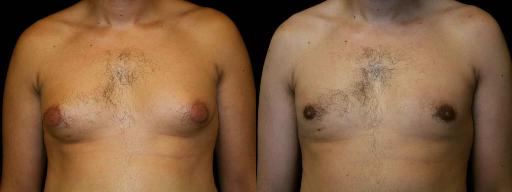 Gynecomastia Patient 7 Before & After