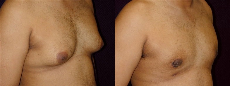 Gynecomastia Patient 21 Before & After