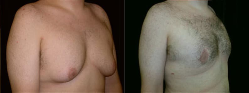 Gynecomastia Patient 9 Before & After Details