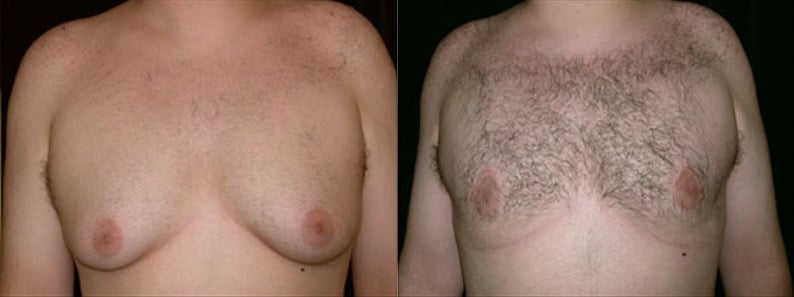 Gynecomastia Patient 9 Before & After