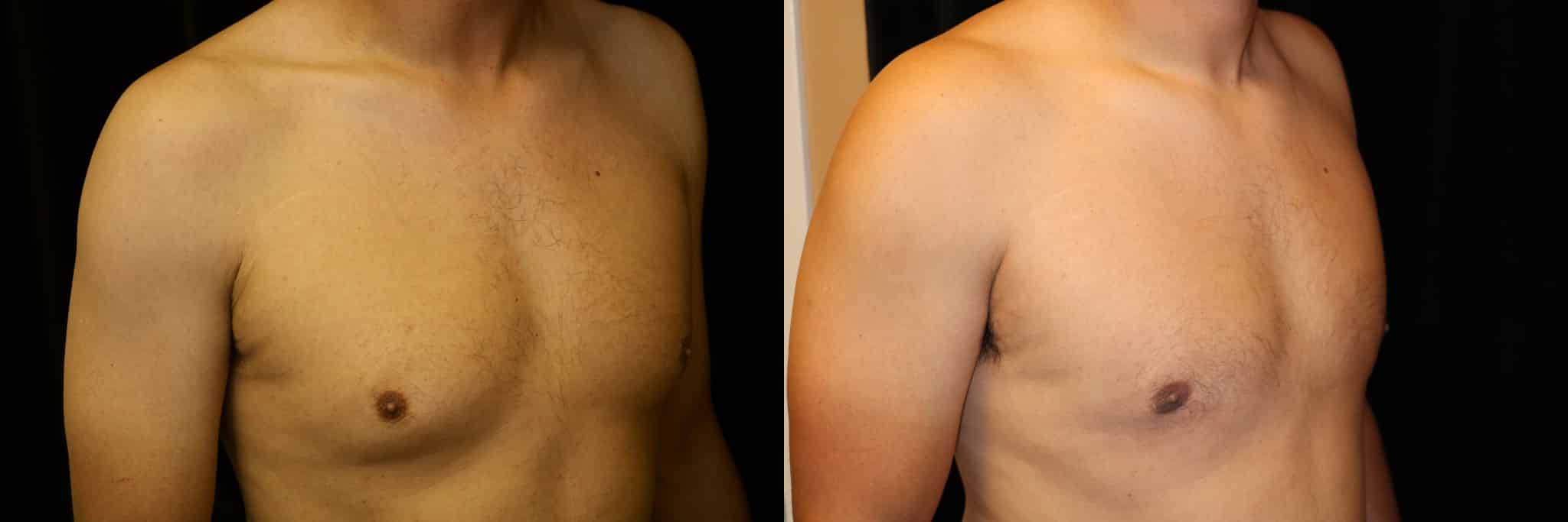 Gynecomastia Patient 3 Before & After Details