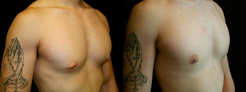 Gynecomastia Patient 10 Before & After Details