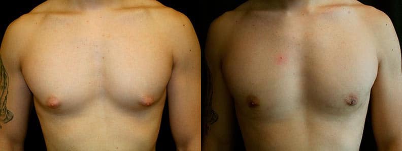 Gynecomastia Patient 10 Before & After