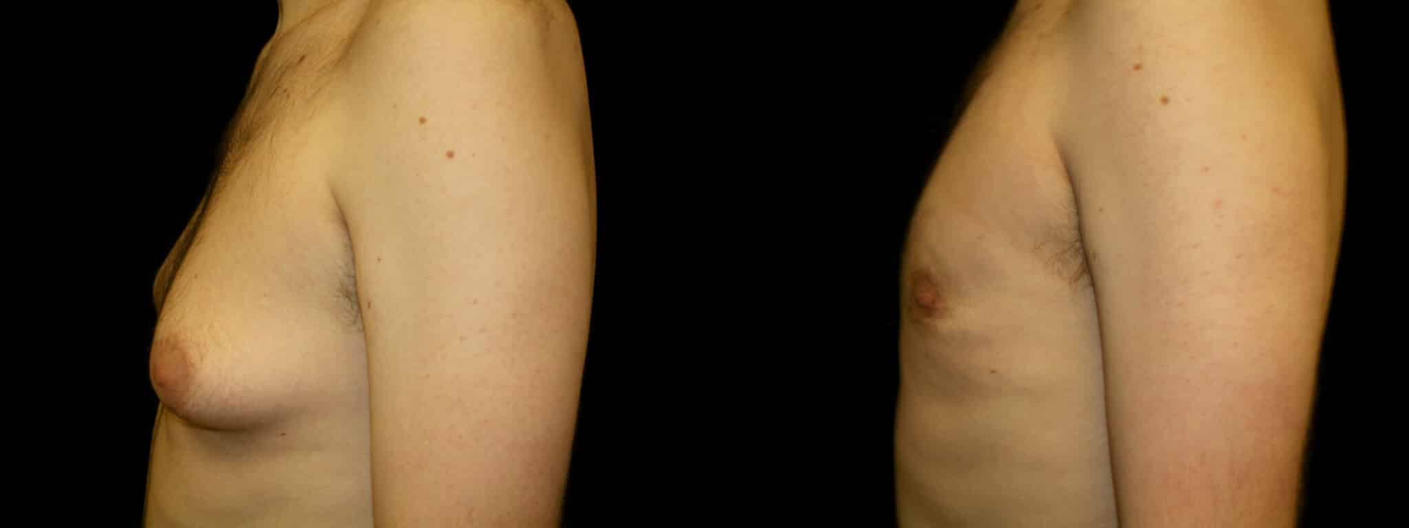 Gynecomastia Patient 11 Before & After Details