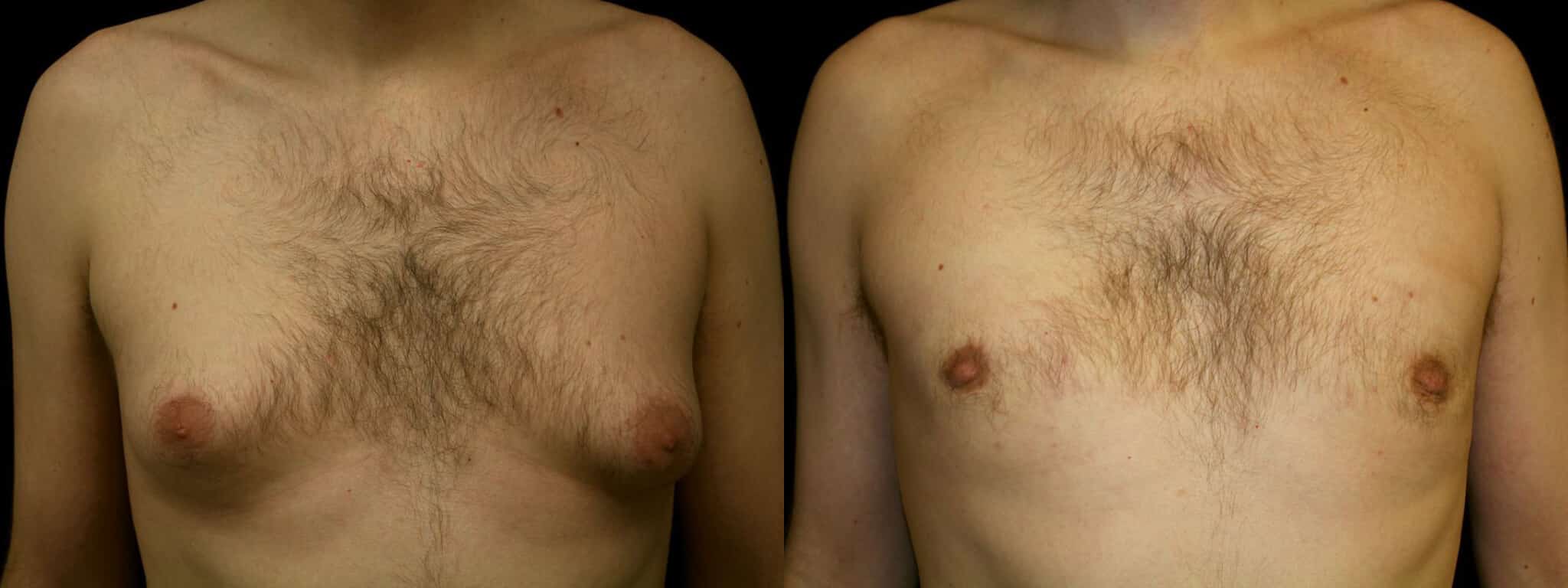 Gynecomastia Patient 11 Before & After