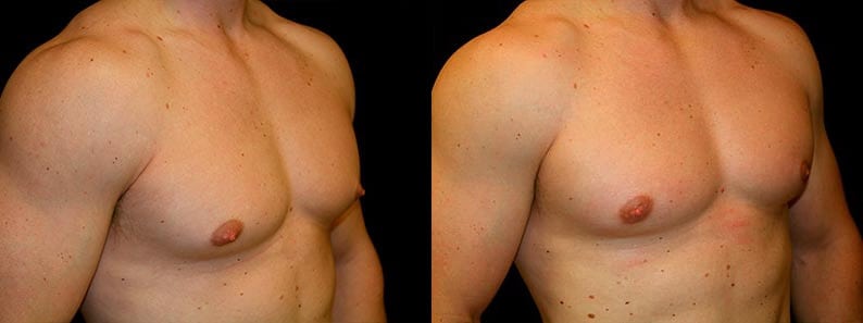 Gynecomastia Patient 18 Before & After Details