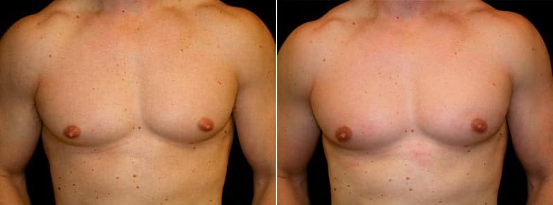 Gynecomastia Patient 18 Before & After