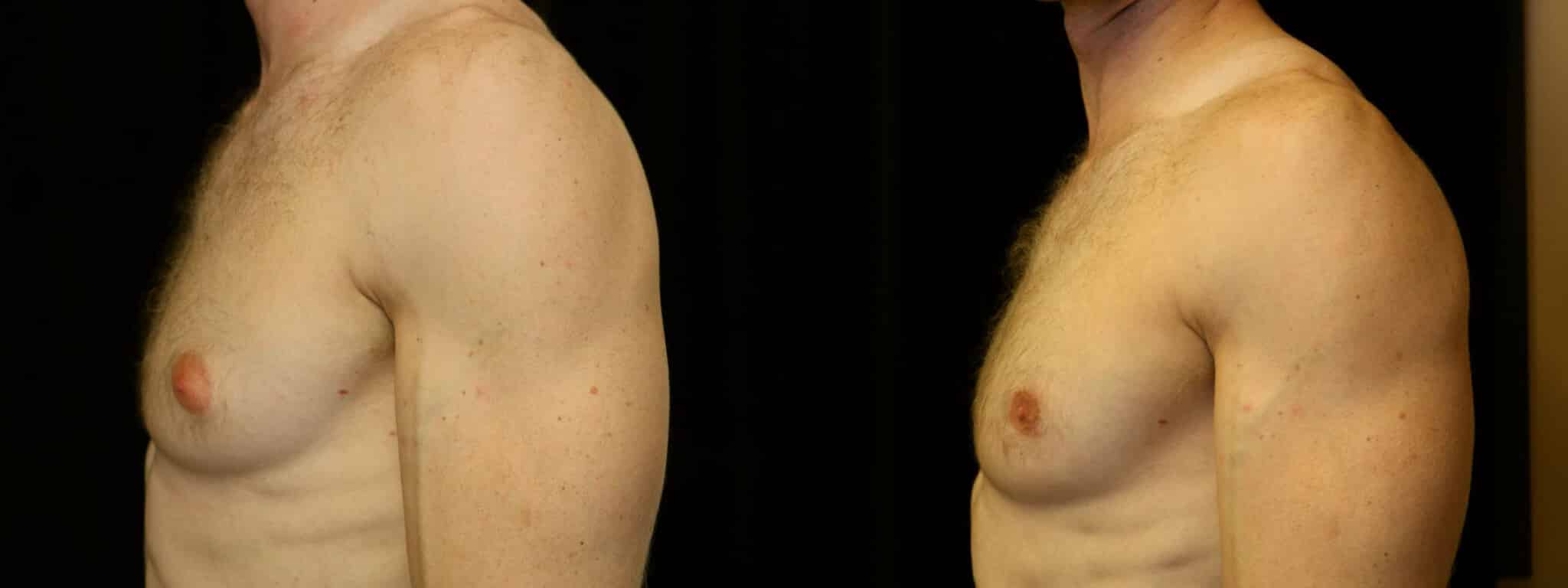 Gynecomastia Patient 7 Before & After Details