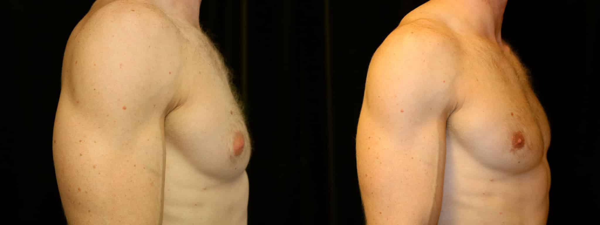 Gynecomastia Patient 7 Before & After Details