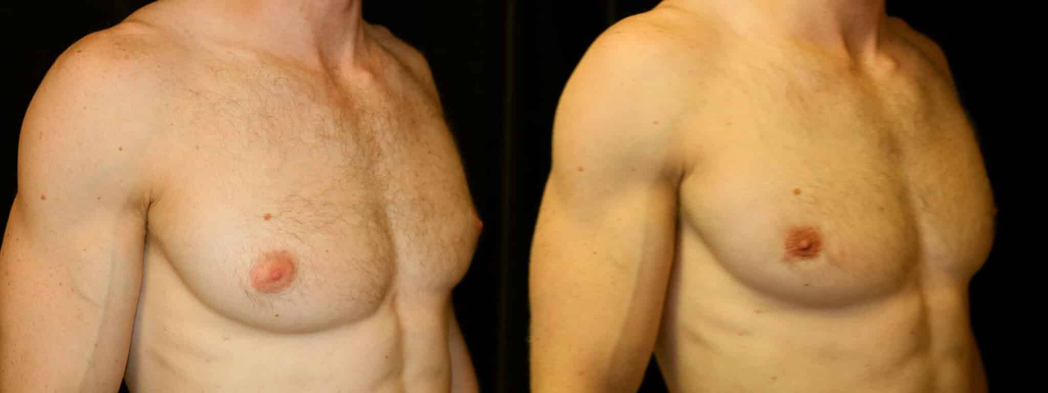 Gynecomastia Patient 7 Before & After Details