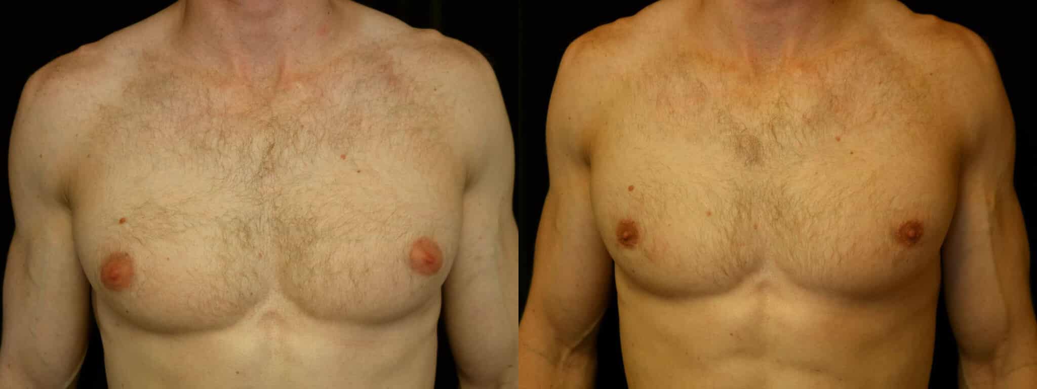 Gynecomastia Patient 7 Before & After