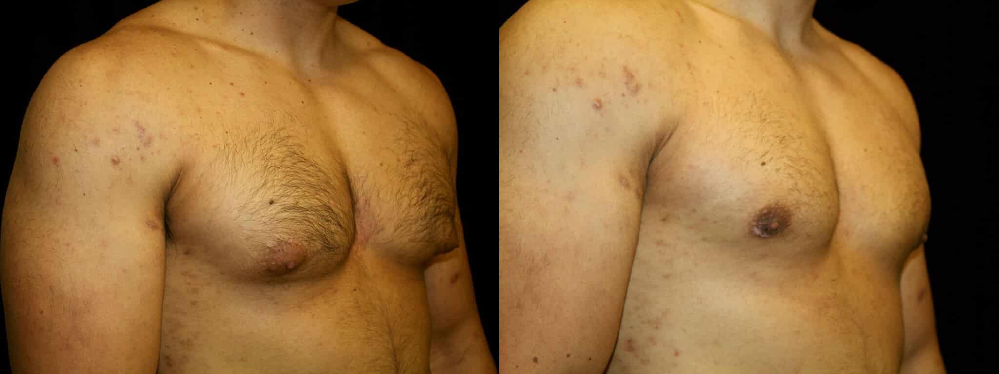 Gynecomastia Patient 21 Before & After Details