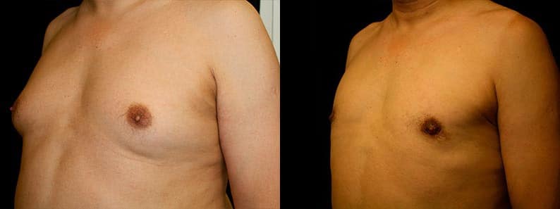 Gynecomastia Patient 7 Before & After Details