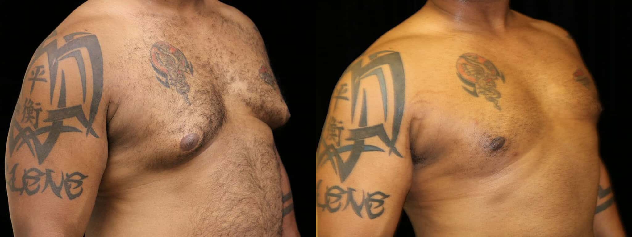 Gynecomastia Patient 8 Before & After Details