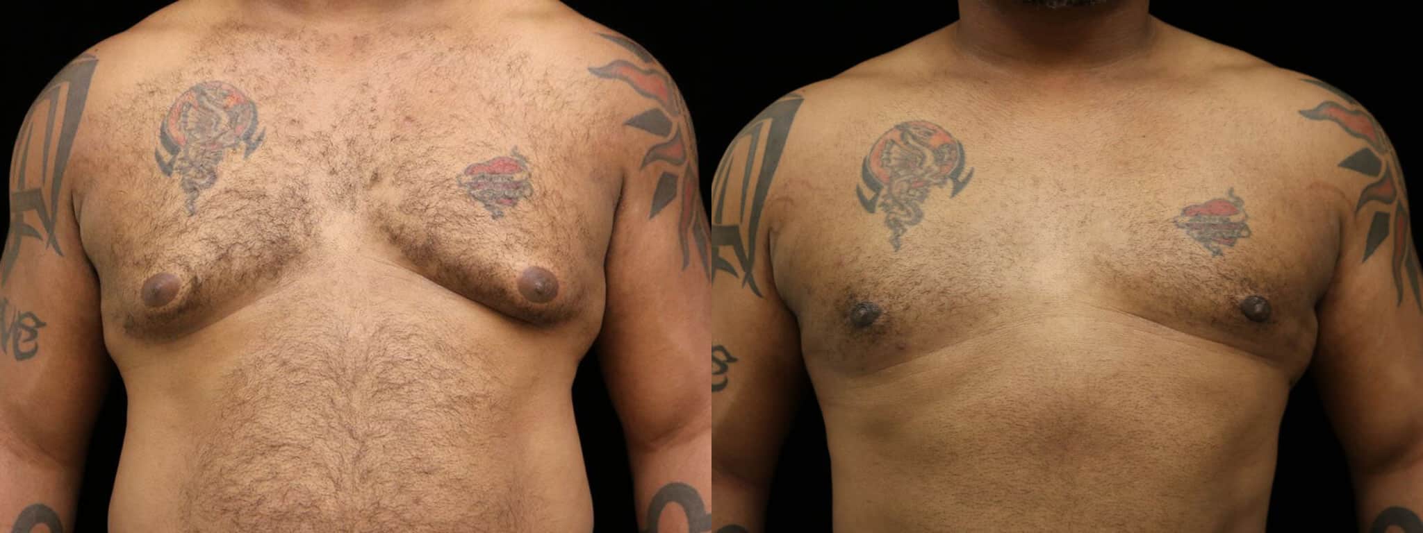 Gynecomastia Patient 8 Before & After