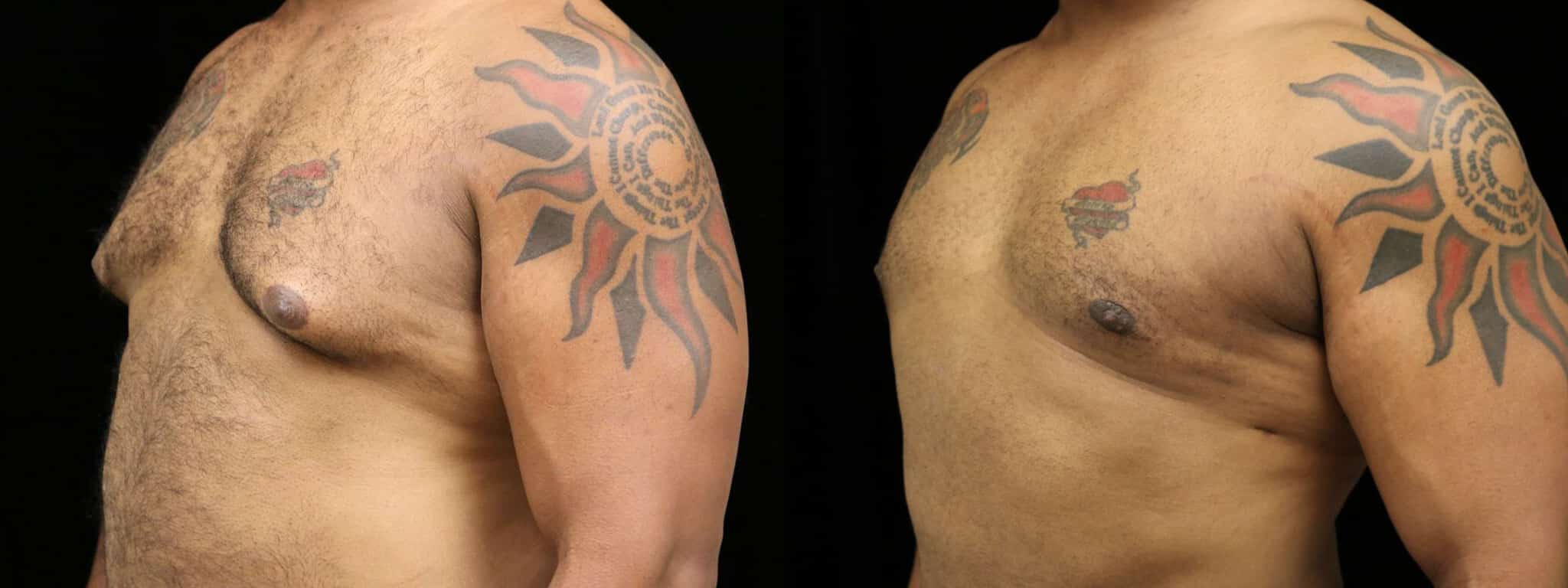 Gynecomastia Patient 8 Before & After Details