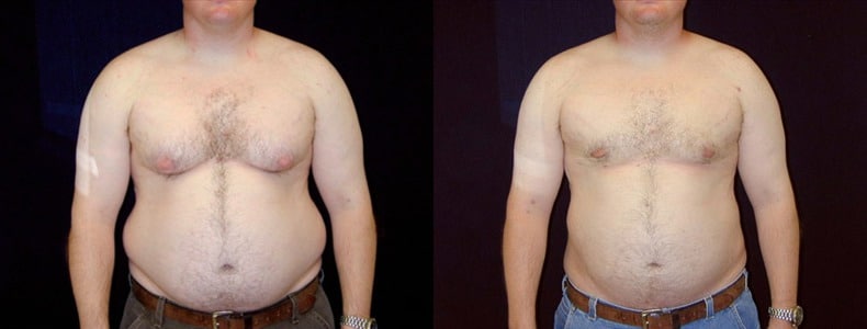 Gynecomastia Patient 16 Before & After