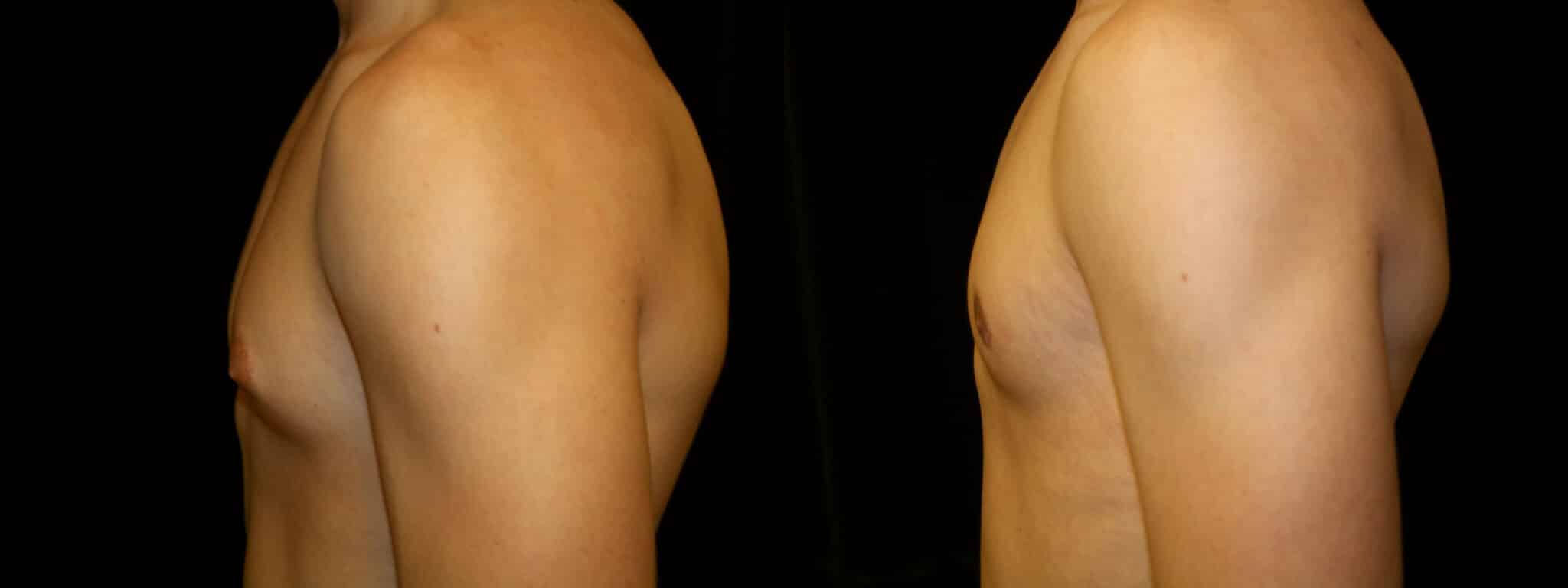 Gynecomastia Patient 11 Before & After Details