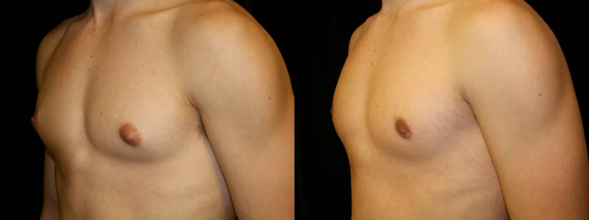 Gynecomastia Patient 11 Before & After Details