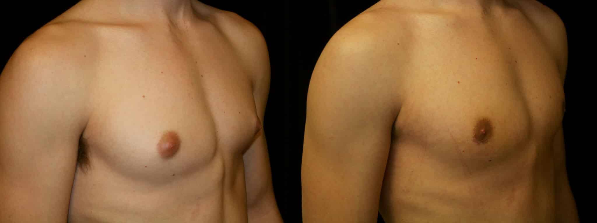 Gynecomastia Patient 11 Before & After Details