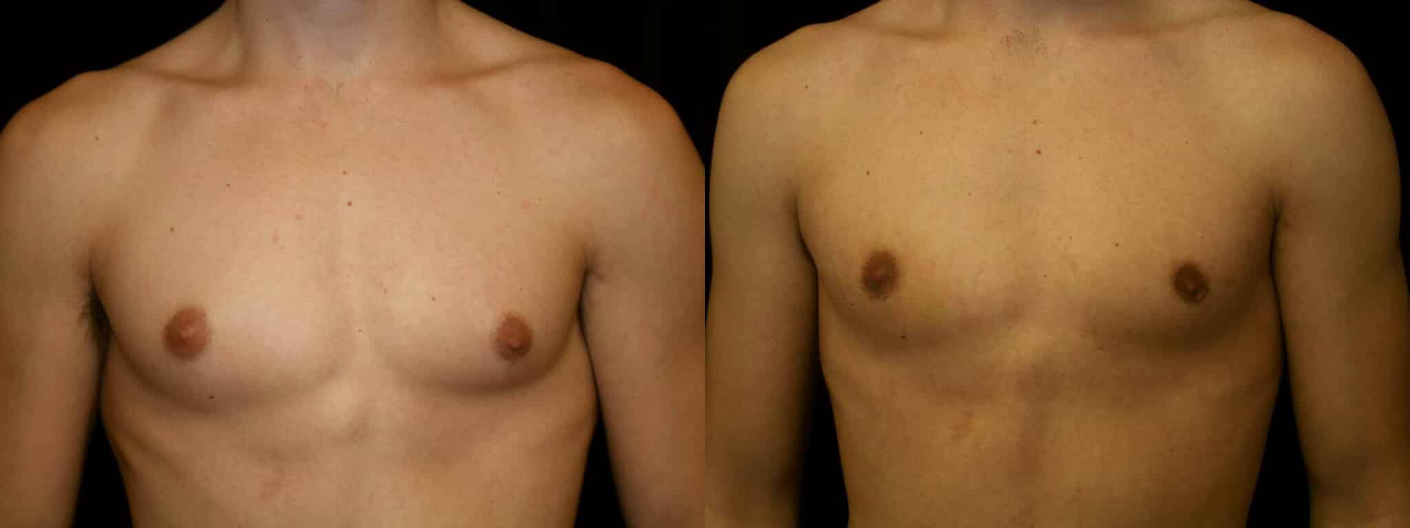 Gynecomastia Patient 11 Before & After