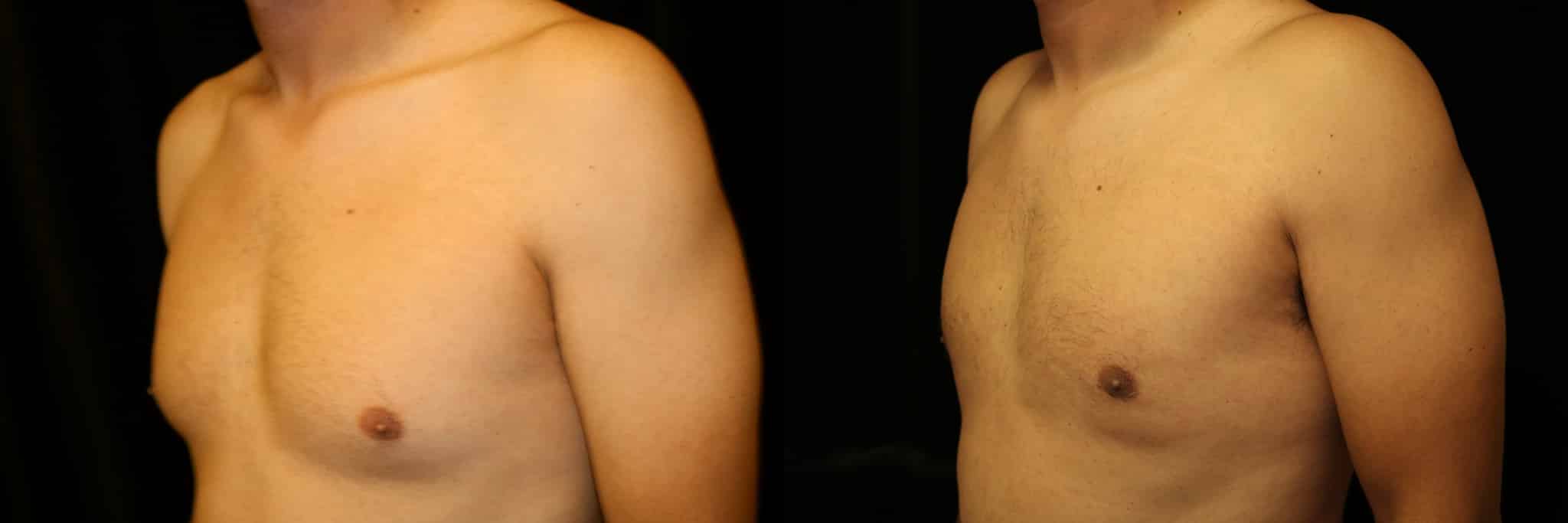 Gynecomastia Patient 3 Before & After Details