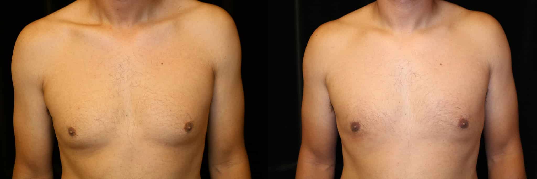 Gynecomastia Patient 3 Before & After