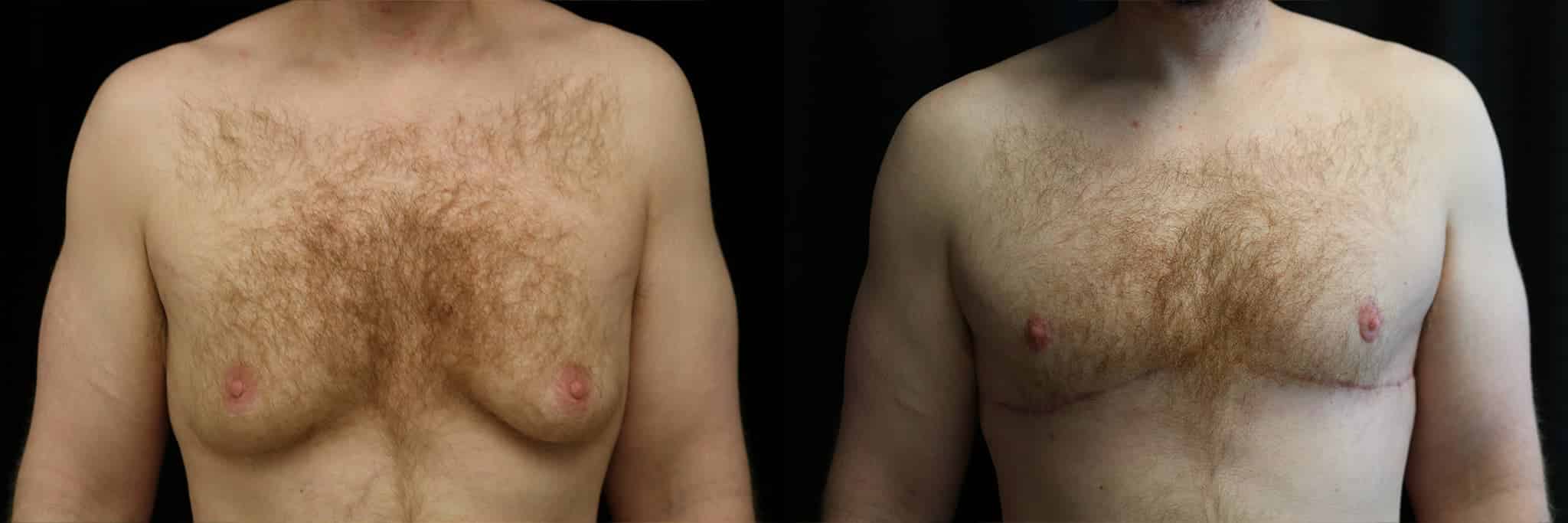 Gynecomastia Patient 5 Before & After