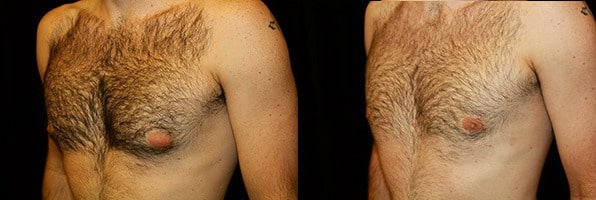 Gynecomastia Patient 11 Before & After Details