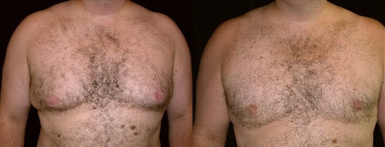 Gynecomastia Patient 10 Before & After