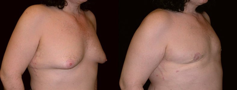 Gynecomastia Patient 14 Before & After